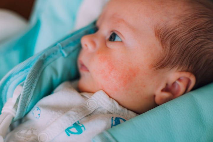 What Are the Causes of Baby Allergies?
